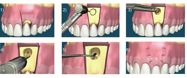 resection d'un granulome dentaire